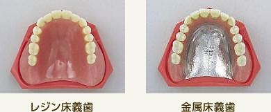レジン床義歯と金属床義歯