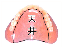 4箇所で義歯を固定（4点支持）と2箇所で義歯を固定（2点支持）
