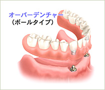 オーバーデンチャー（ボールタイプ）