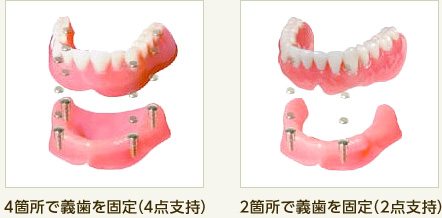 4箇所で義歯を固定（4点支持）と2箇所で義歯を固定（2点支持）