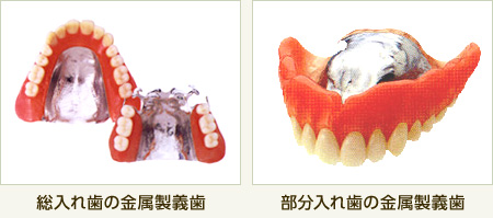 総入れ歯の金属製義歯、部分入れ歯の金属製義歯