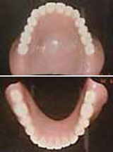 レジン床義歯と金属床義歯